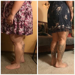 Novo estudo define critérios de diagnóstico por imagem do lipedema, que afeta 12% das brasileiras